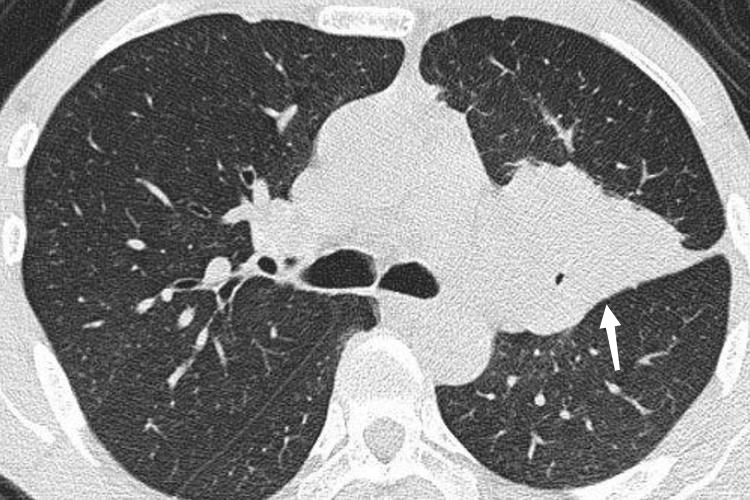 中央型肺癌CT图