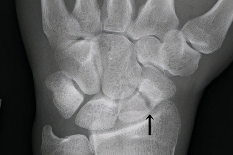 腕舟状骨骨折图