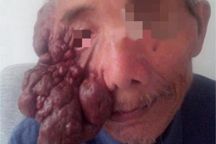 进行性结节性组织细胞瘤脸肉瘤图