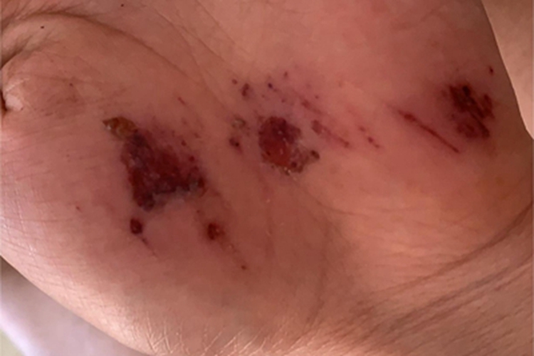 擦伤手掌血痂图 擦伤手掌血痂图