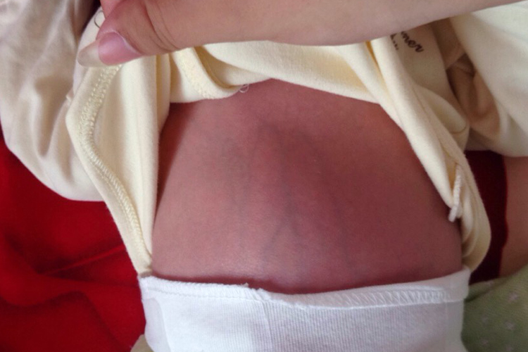 小孩肚子上正常的青筋图