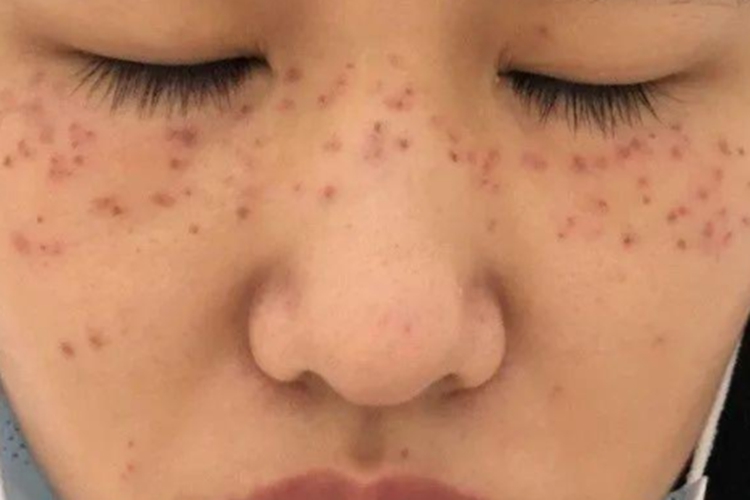 激光祛斑结痂图