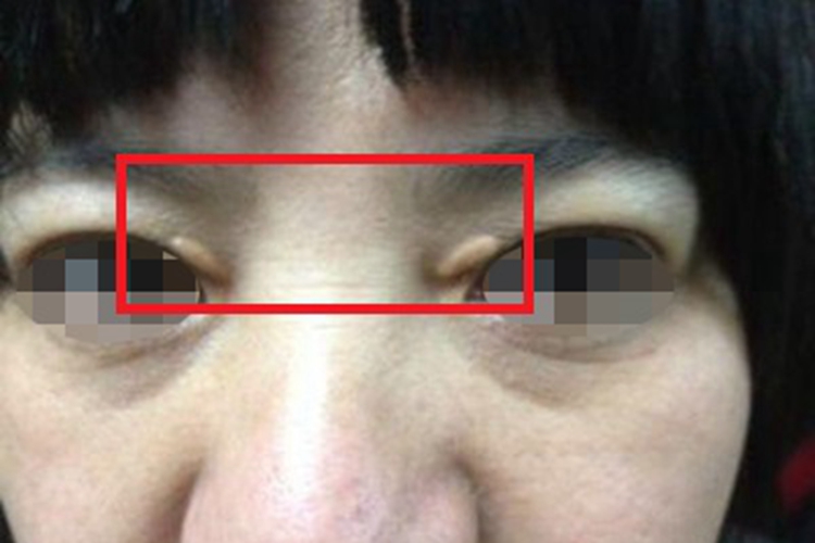 泛发性扁平黄色瘤长疙瘩图