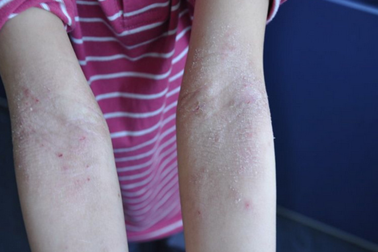 干性湿疹脱屑图