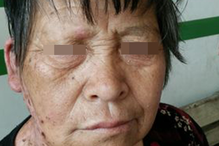 面神经炎嘴角下垂图