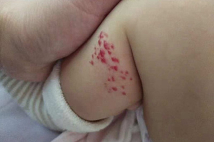 婴儿血管瘤大腿症状图