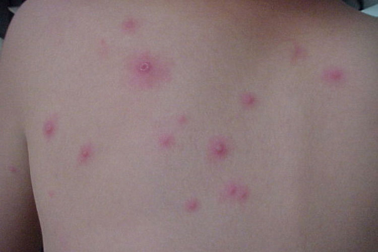 水痘的丘疹图