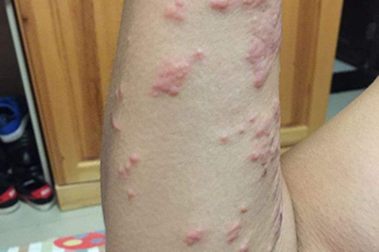 血吸虫尾蚴皮炎小红疙瘩图