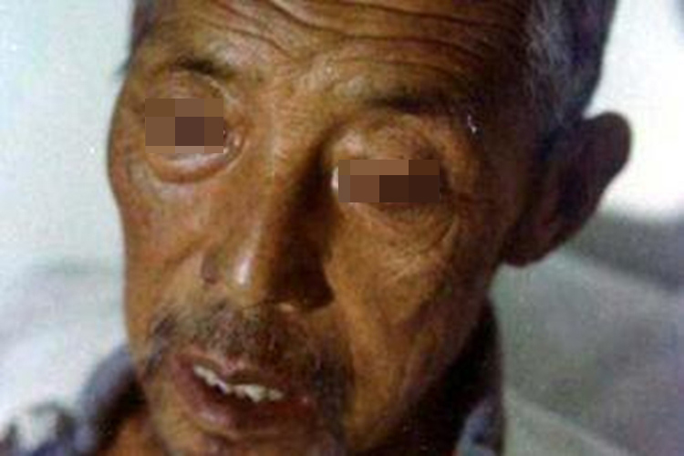 肾阳虚面色晦暗图