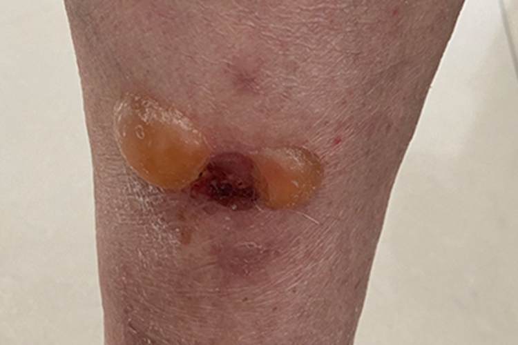 大疱性类天疱疮小腿症状图