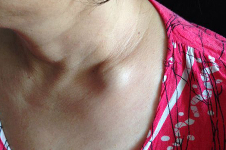 左锁骨上骨肉瘤硬疙瘩图