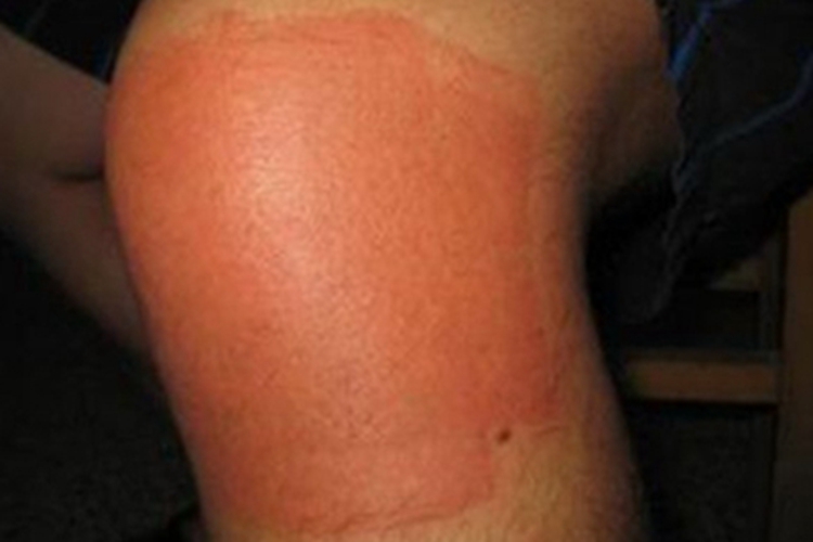 皮革皮炎膝盖方形红斑图