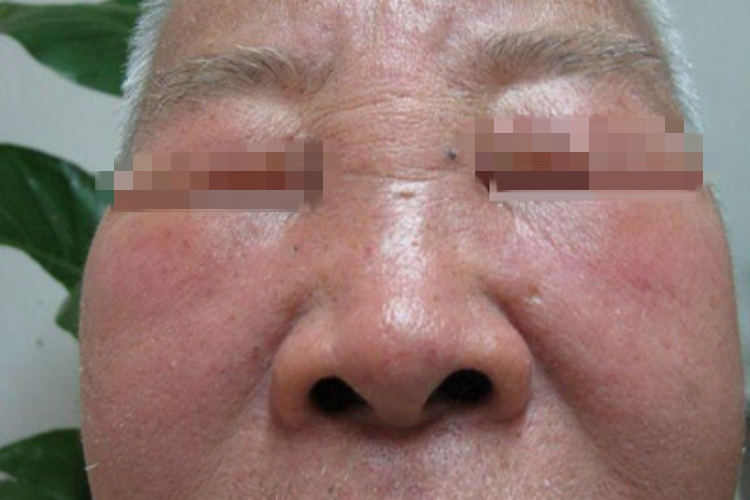 蛋白质营养不良脸水肿图 蛋白质营养不良脸水肿图