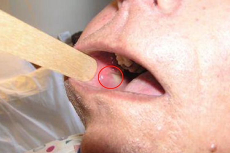 急性化脓性腮腺炎口腔疙瘩图 急性化脓性腮腺炎口腔疙瘩图