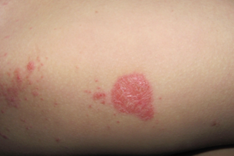 股癣大腿根有红斑和红点图 股癣大腿根有红斑和红点图