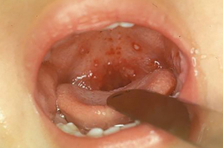 咽峡炎咽峡红肿图