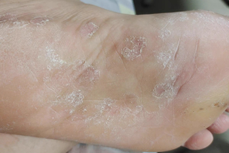 足癣皮肤粗糙图