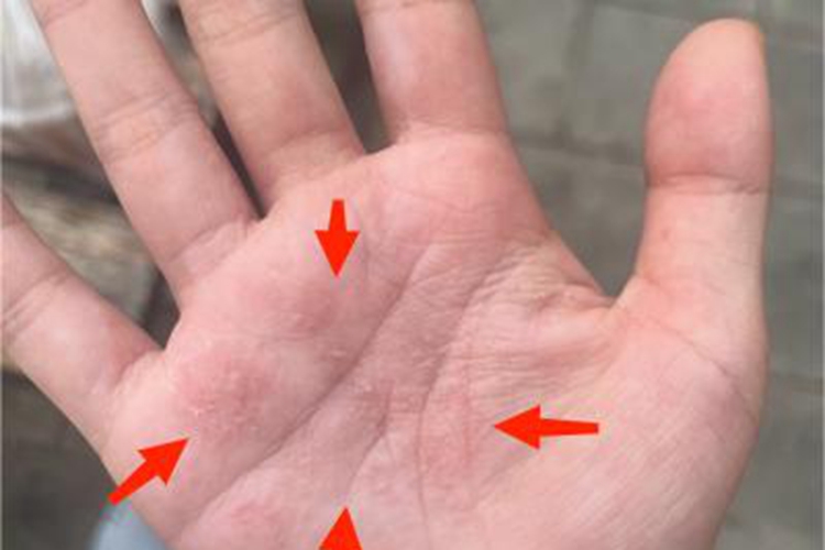 汗疱疹右手掌有许多小疙瘩图