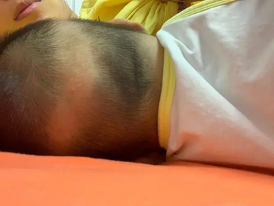 新生儿佝偻病后脑勺有一条没有头发图.jpg
