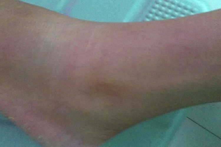 轻度扭伤脚踝红肿图