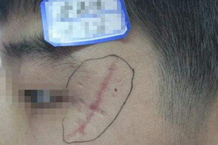 萎缩性瘢痕眼周有凹陷瘢痕图