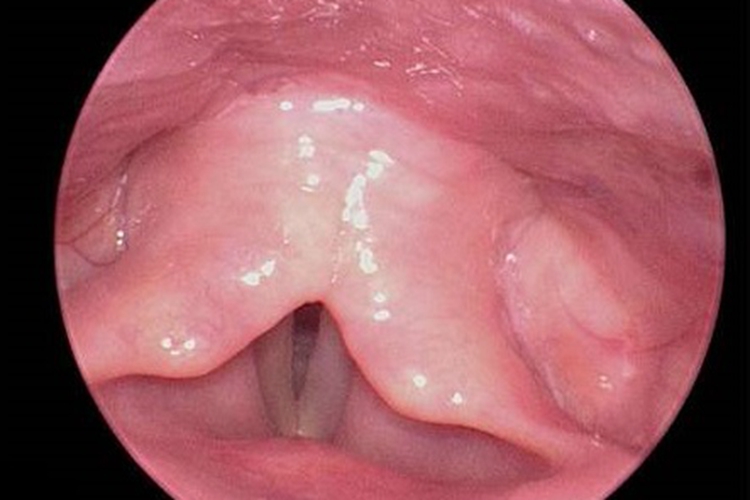 喉水肿黏膜水肿图
