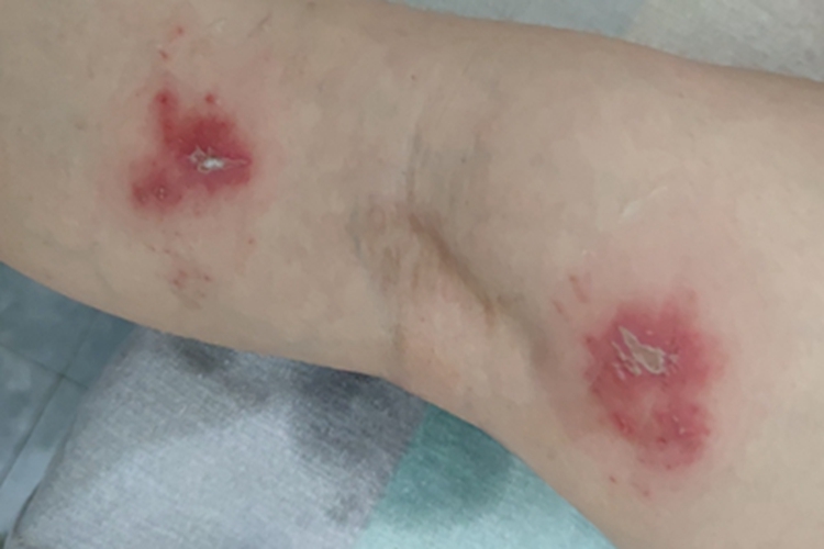 隐翅虫皮炎腿脓包图 隐翅虫皮炎腿脓包图