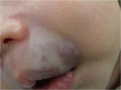 静脉畸形上嘴唇皮肤出现明显的发青图.png