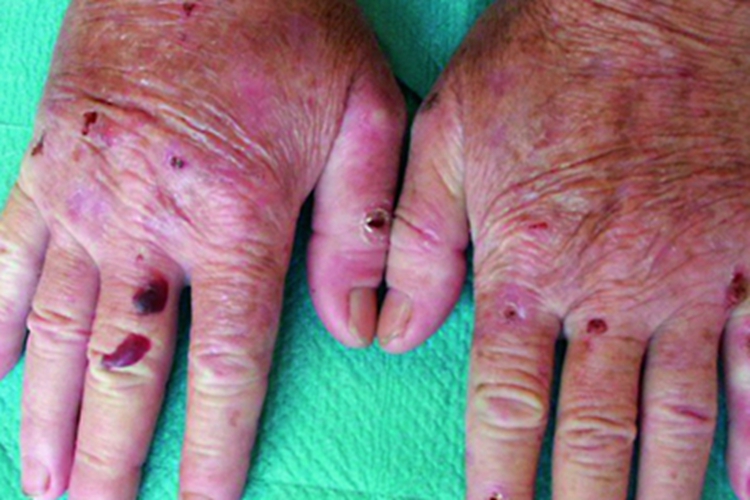 红细胞生成性原卟啉病手部血疱图 红细胞生成性原卟啉病手部血疱图