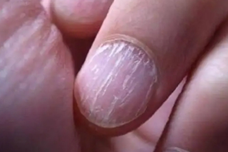 甲纵裂手指甲开裂图