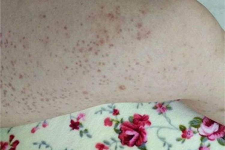 皮下出血大腿红点图