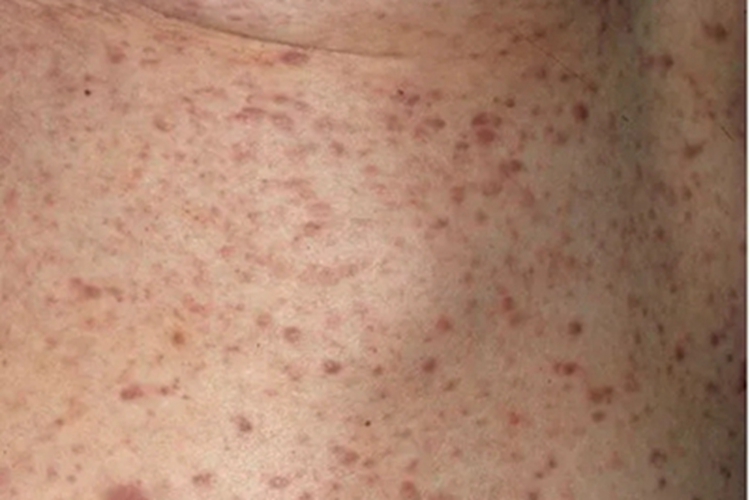 皮肤白血病特异性损害丘疹图 皮肤白血病特异性损害丘疹图