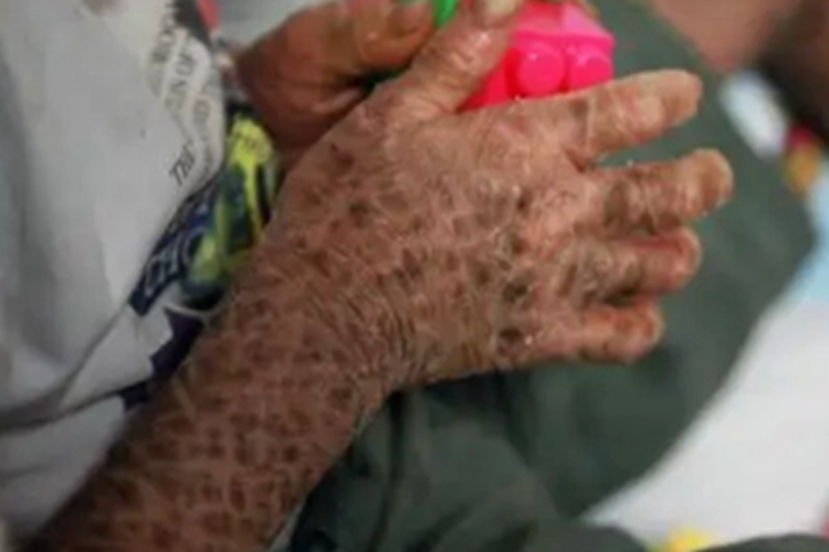 鱼鳞病手部症状图 鱼鳞病手部症状图