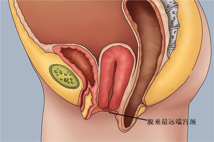 Ⅰ度子宫脱垂图 Ⅰ度子宫脱垂图