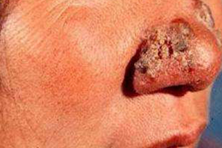 鼻恶性肉芽肿鼻翼结痂图