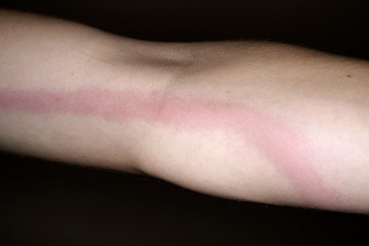 逆行性淋巴管炎图 逆行性淋巴管炎图