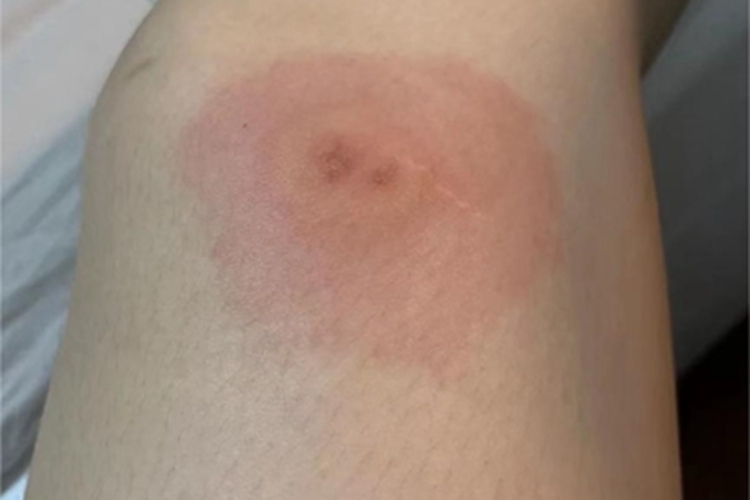 蚊虫叮咬膝盖疙瘩图 蚊虫叮咬膝盖疙瘩图