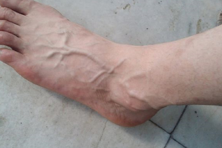 脚背静脉血栓突起图