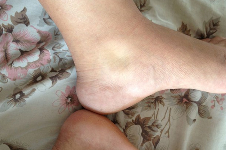 心源性脚水肿图