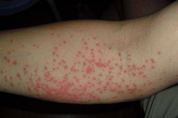 皮革皮炎胳膊红点图