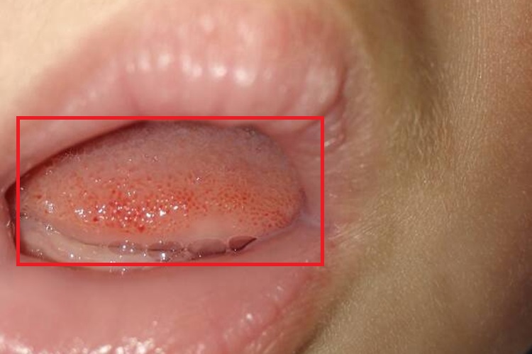 舌炎舌头红点图