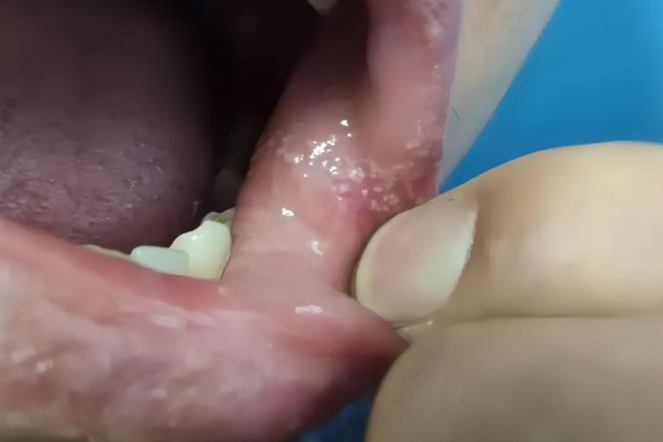 皮脂腺异位症白色疙瘩图 皮脂腺异位症白色疙瘩图