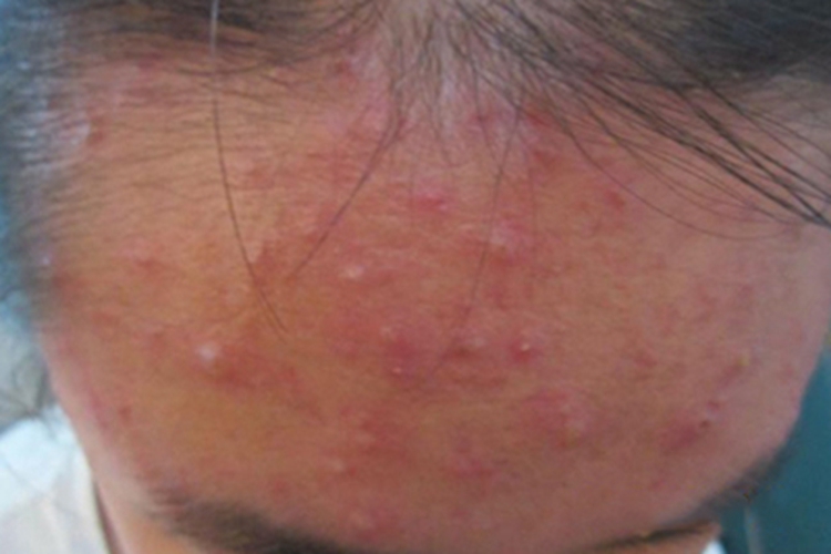 水痘额头长满红疙瘩和小疱图