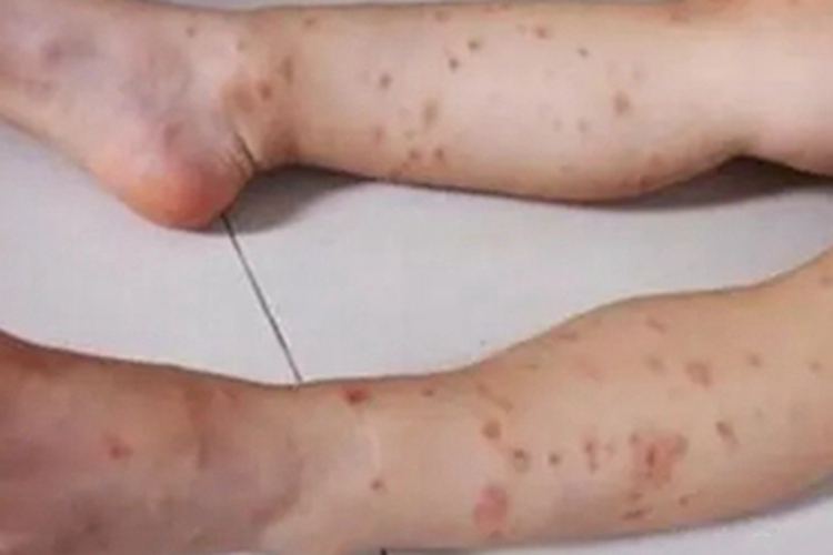 蠓叮咬小腿有好多红斑图 蠓叮咬小腿有好多红斑图