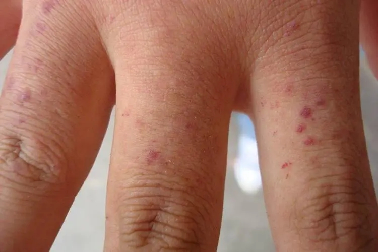 肢端血管角化瘤图