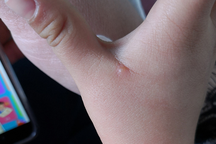 手部传染性软疣图