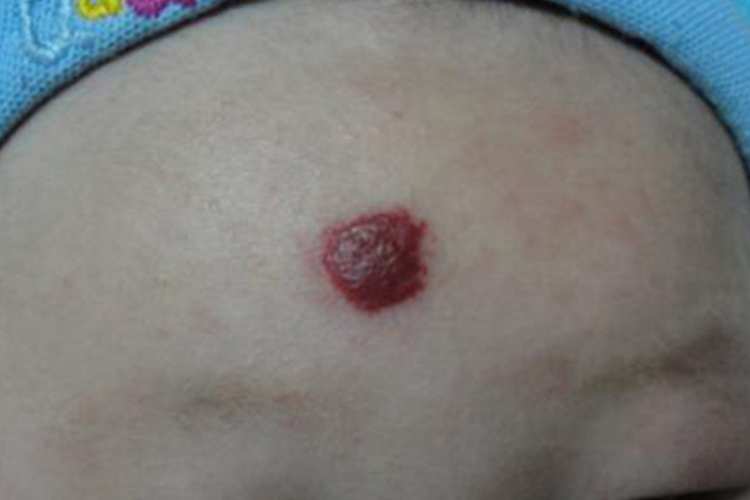 婴儿血管瘤图 婴儿血管瘤图