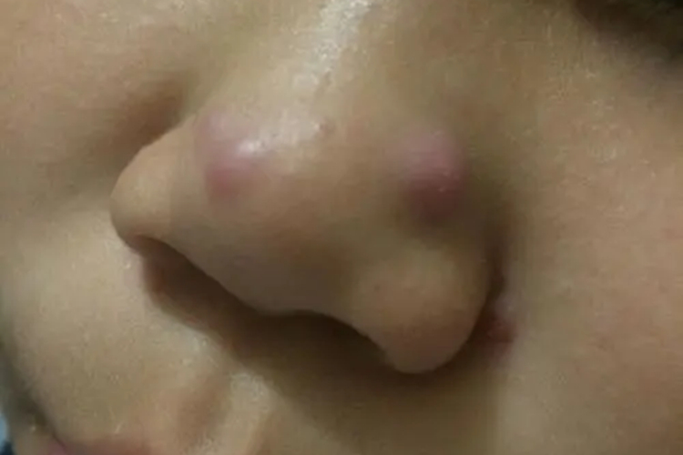 良性幼年黑素瘤鼻尖症状图