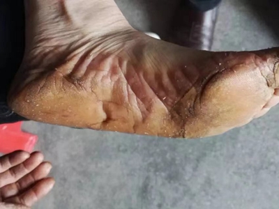 获得性掌跖角化病脚底增厚发黄图.jpeg