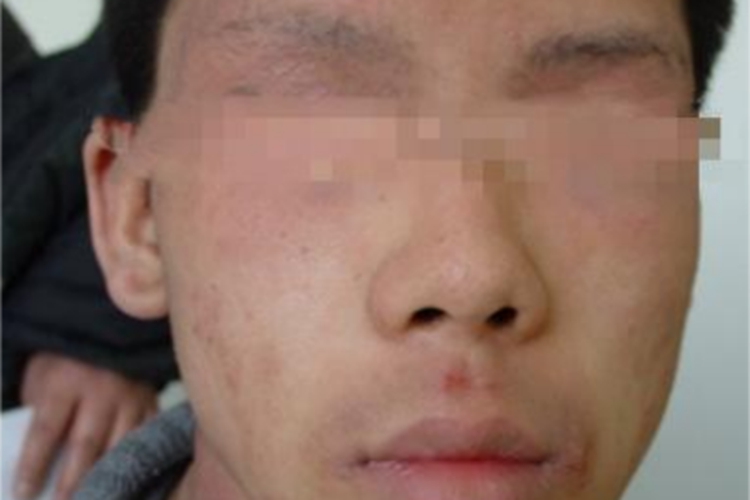 青年成人期特应性皮炎眼周红斑图片_有来医生